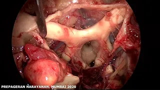 Complete Anterior Skull Base Dissection: Mumbai 2020