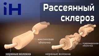 Рассеянный склероз: причины, симптомы, диагностика, лечение | iНЕВРОЛОГ