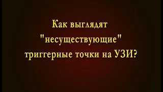 Как выглядят "несуществующие"триггерные точки на УЗИ?