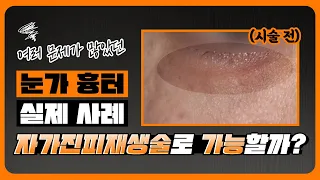 다양한 문제들이 많았던 #눈가흉터 자가진피재생술로 없앨 수 있을까?