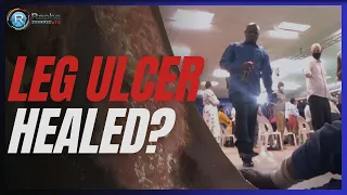 Leg Ulcer Healed? Watch this!