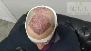 Пересадка волос в Москве. Результат сразу после операции