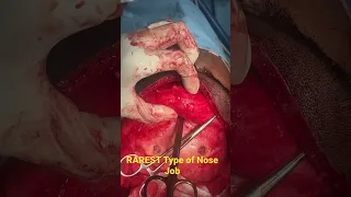 RAREST TYPE OF RHINOPLASTY IN THE ENTIRE WORLD!!