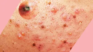 Removing BLACKHEADS AND PIMPLES 😱 Extremely Satisfying Video 😋