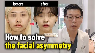 [EN/JP] How to solve the facial asymmetry l Korean facial asymmetry surgery case review