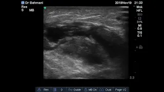 Case 220 : Subcutaneous abscess