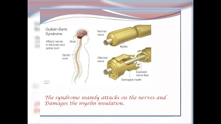 Guillain Barre Syndrome ( GBS ) easily explained