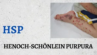 Henoch-Schönlein Purpura|| HSP