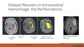 Common Approaches to Less Common Strokes: Recovery Trajectories in ICH (Mar. 5, 2024)