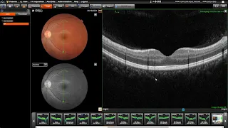 Topcon Maestro2: Retina Specific Scan