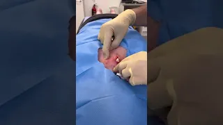 Large Cyst Removed on The Back