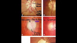 Optic Atrophy - Clinical Appearance of Each Type #Shorts