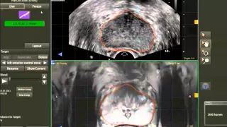 How to perform a prostate fusion guided biopsy: UroNav v 1.1