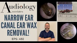 NARROW EAR CANAL EAR WAX REMOVAL - EP492