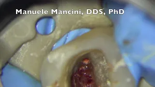 Dr. Manuele Mancini - Riassorbimento Interno - Endodonzia - Internal Resorption - Endodontics