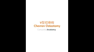 V型切骨術 Chevron Osteotomy，拇指外翻的救星｜Complete Anatomy
