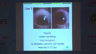 AIOC2019   GP18   Topic   Peripheral corneal infiltrates Differential diagnosis   Dr Rajat Jain