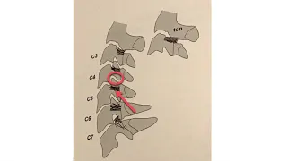 Cervical Facet Syndrome Treated with the Laser Part 2