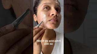 Peel of acne patch. #acne #acnepatch #pimplepatch #cystic #cystpoping #cyst #acnetreatment #pimples