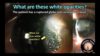 CataractCoach 1228: ruptured globe injury with white opacities