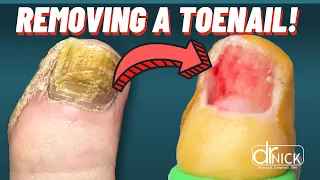 Fungal Toenail Removal by Dr. Nick Campitelli: A Pain-Free Solution to Healthy Feet!