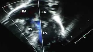 Hypoplastic Right Heart Syndrome(HRHS)