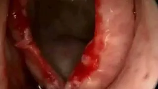 Ethmoid Mucocele with Orbital Displacement