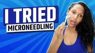 OMG! I TRIED MICRONEEDLING at home │See What Happened!