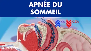 Apnée du sommeil ©