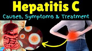 Hepatitis C – Symptoms, Causes, Pathophysiology, Diagnosis, Treatment, Complications