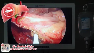 Apendicectomía Laparoscópica (Apendilap) por Apendicitis Aguda Complicada con Peritonitis Generaliz