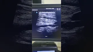 extensive Acute DVT doppler ultrasound