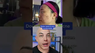Derm reacts to amazing acne transformation without Accutane! #acne #accutane #dermreacts