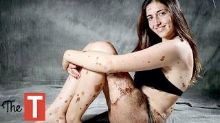 10 Teenagers With Rare Diseases Who Are Happier Than You