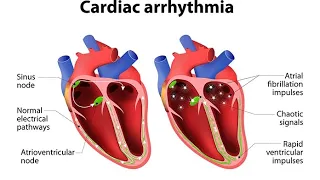 Cardiac Arrhythmia - Nurse