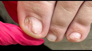 Stripping / Pedicure / Foot treatment