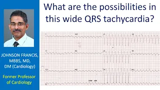 What are the possibilities in this wide QRS tachycardia?