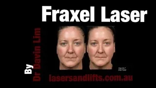 How long does it take to recover from Fraxel laser?