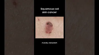 What do basal cell and squamous cell skin cancers look like?