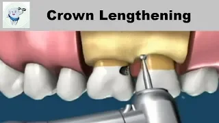 Crown Lengthening Procedure Animation