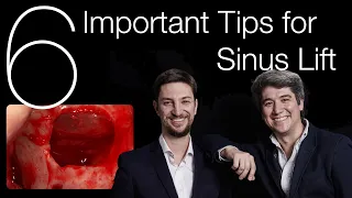 🇺🇸 6 Important Tips for Sinus Lift & and BONE GRAFT - Implantology Talks