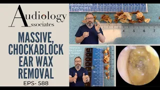 MASSIVE CHOCKABLOCK EAR WAX REMOVAL - EP588