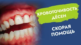 Кровоточивость дёсен. Скорая помощь.