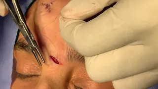 Simple Interrupted Suturing - Perfect Wound Closure