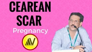 Cesarean Scar Pregnancy