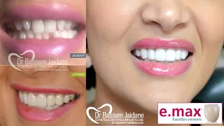 Facettes dentaires veneers e max : Dr bassem jaidane. Vacance Tunisie