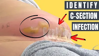 How to Identify C-Section Infection