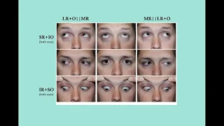 Strabismus   CRASH! USMLE Step 2 and 3