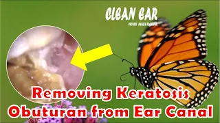20  Removing Keratosis Obuturan from Ear Canal