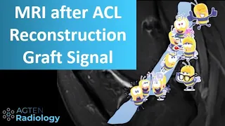 Knee MRI after ACL Reconstruction Surgery - Part 1 - Signal intensity